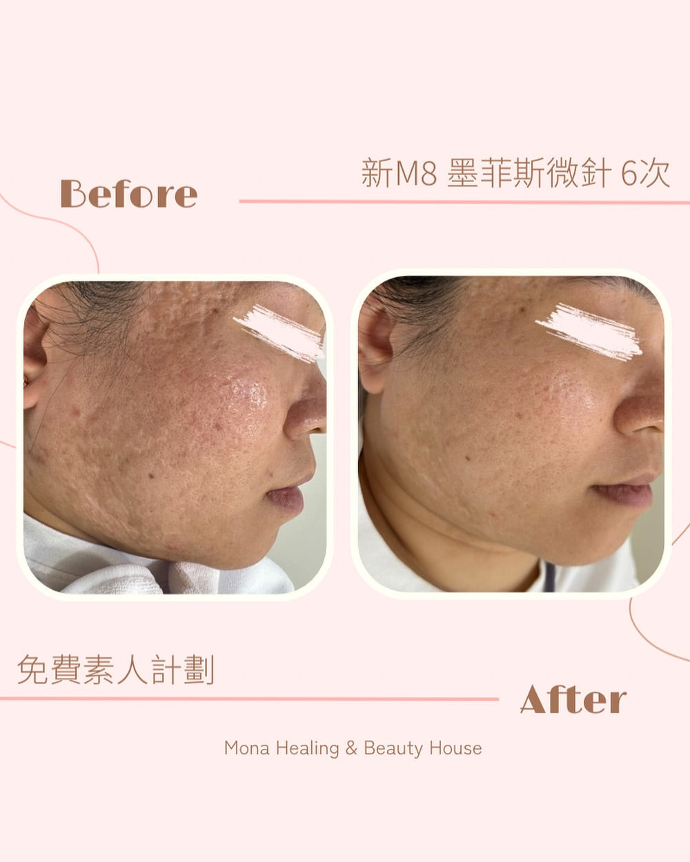 拆解凹凸洞與暗瘡印成因及類型!比較4大治療方法!(copy)