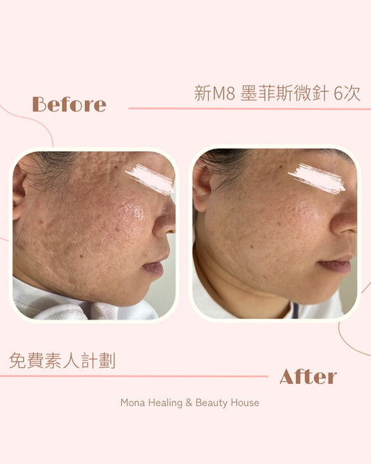 拆解凹凸洞與暗瘡印成因及類型！比較4大治療方法！(copy)